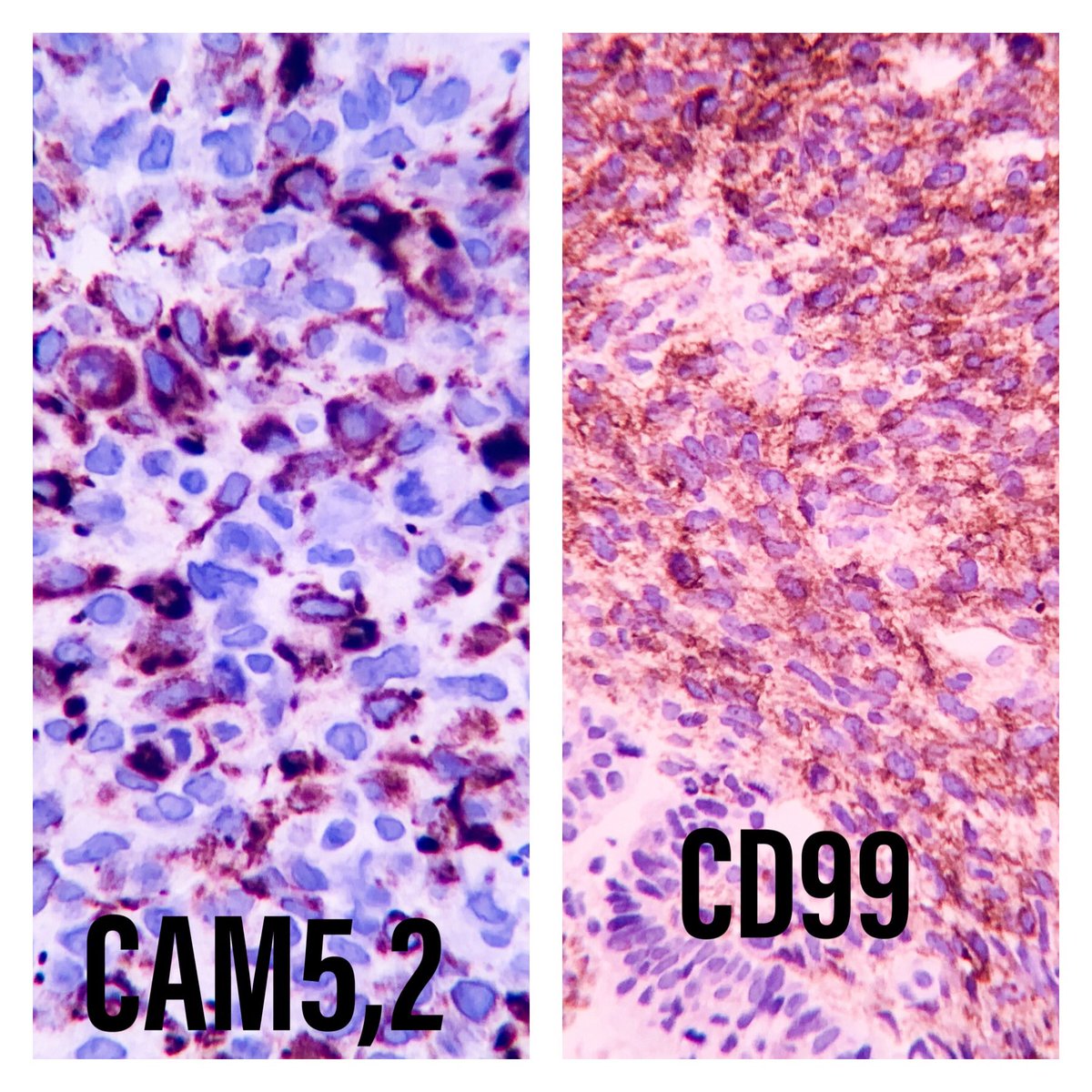EIacovou's tweet image. 67yo male with polyploid nasal mass.  A biopsy was taken. #pathology  #twitterpath #headneckpath