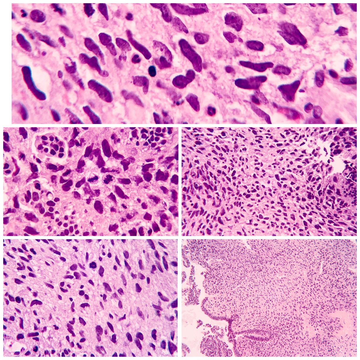 EIacovou's tweet image. 67yo male with polyploid nasal mass.  A biopsy was taken. #pathology  #twitterpath #headneckpath