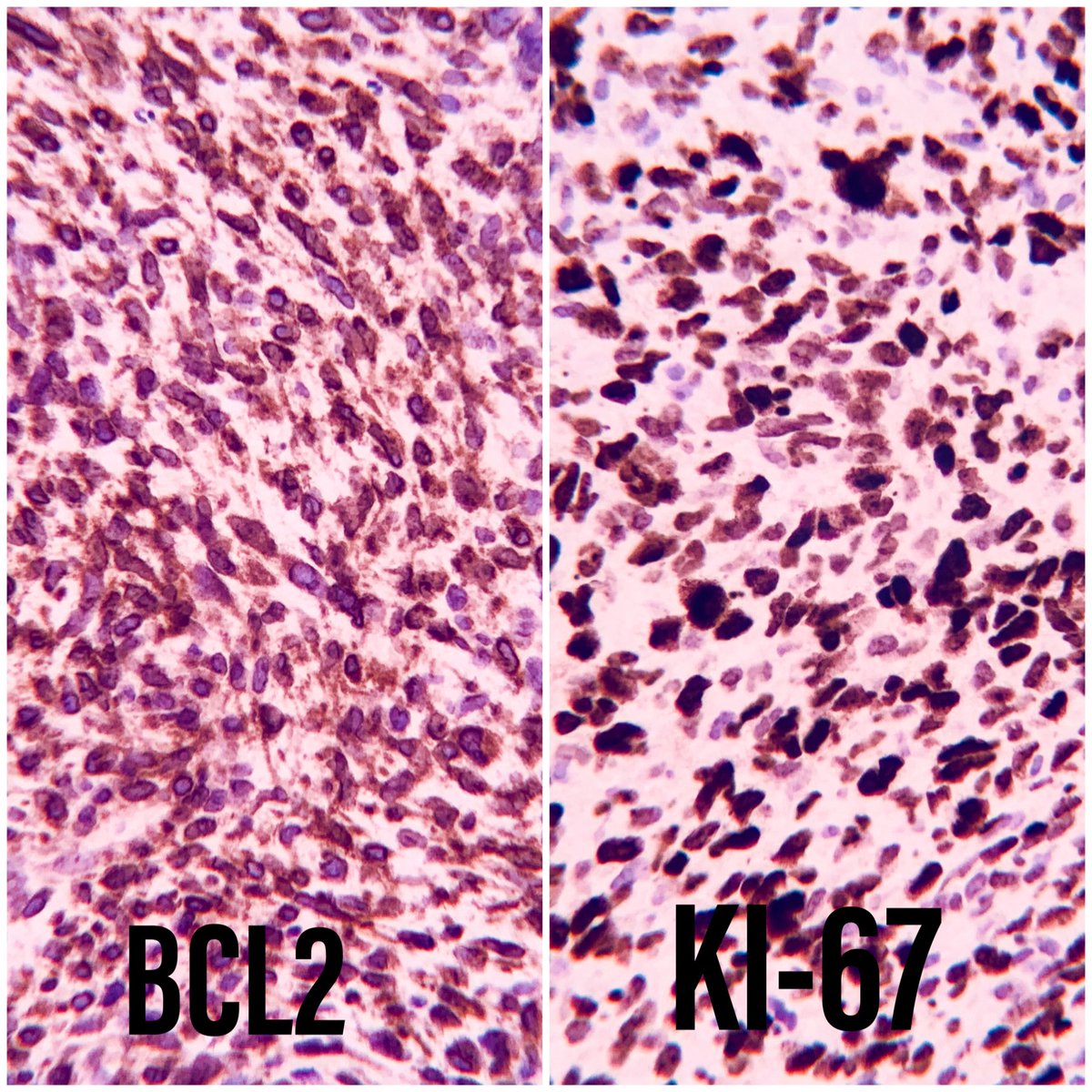 EIacovou's tweet image. 67yo male with polyploid nasal mass.  A biopsy was taken. #pathology  #twitterpath #headneckpath