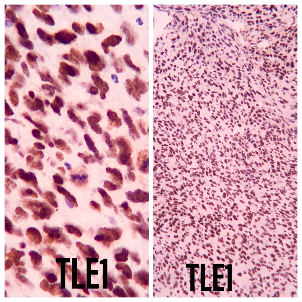 EIacovou's tweet image. 67yo male with polyploid nasal mass.  A biopsy was taken. #pathology  #twitterpath #headneckpath