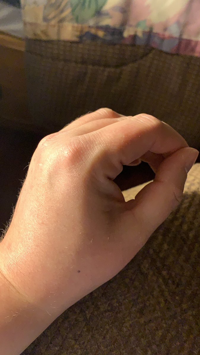 zero_twitches's tweet photo. @sassistheword knuckle vein twins! https://t.co/LPMKJxce04