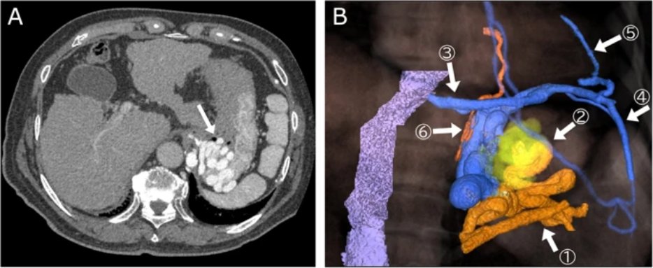 New article! Coil-assisted retrograde transvenous obliteration for the treatment of gastric varices via a single access route using steerable microcatheter: a case report
Read it free of charge: ow.ly/adQe50A7Iqy