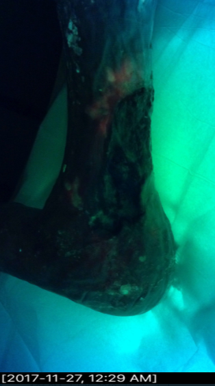 Want to see the impact Debrisoft is having to bacteria &amp; biofilm?

As well as in vitro studies to show the reduction in biofilm &amp; bacteria, using a <a href="/moleculight/">MolecuLight Inc.</a> we can see the reduction Debrisoft can make in just one use 

*Bacteria shown in cyan green &amp; bright red