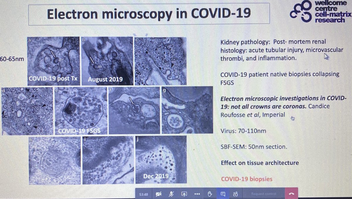 gmnephrology's tweet photo. All is not clear when it comes to renal biopsies and COVID-19 @RLWczyk collecting tissue samples for further analysis. Study nearly ready to go. #gmann https://t.co/y3TfYO1n0I