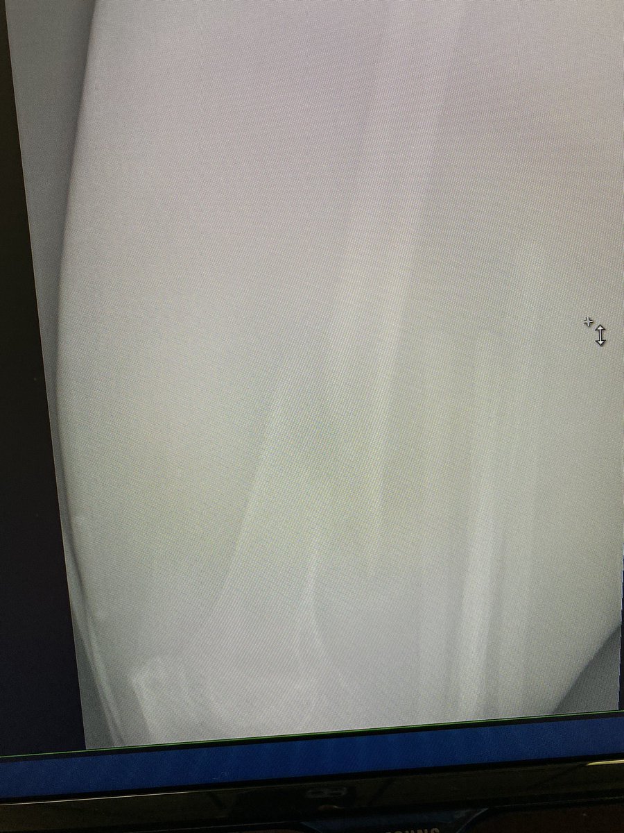 Mid 40s. Non ambulatory. Pain with transfers and self care. Date of injury unknown. Options? #OrthoTwitter