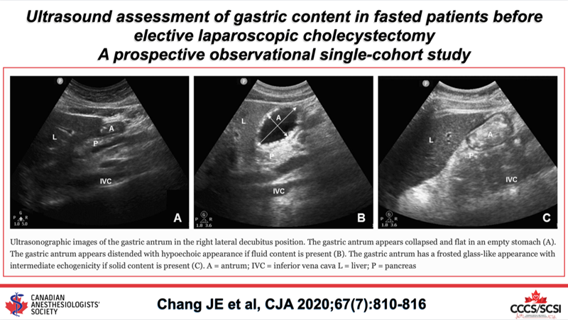 Ultrasound assessment of gastric content in fasted patients before elective laparoscopic cholecystectomy: a prospective observational single-cohort study buff.ly/2YtY07q #CJA #CJA2020 #Anesthesia #Anesthesiology #POCUS