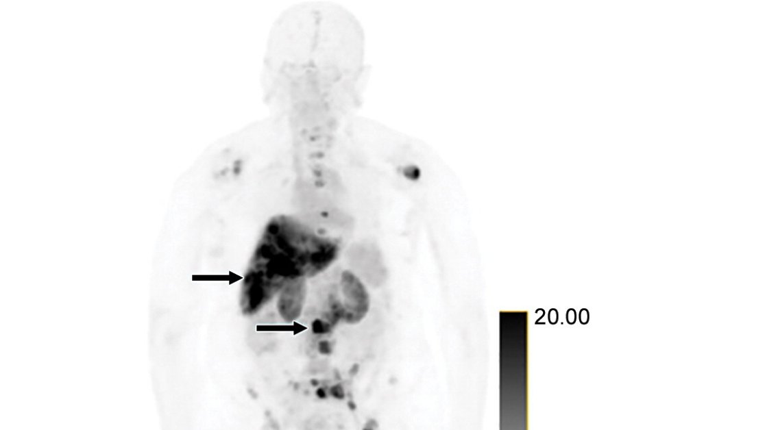 radiology_rsna's tweet photo. Ulaner et al. prospectively detected HER2-positive metastases in women with HER2-negative primary breast cancer using 89-Zr pertuzumab. https://t.co/7Y9Ijnf05e @sloan_kettering #MolecularImaging https://t.co/GUOW9m72Si