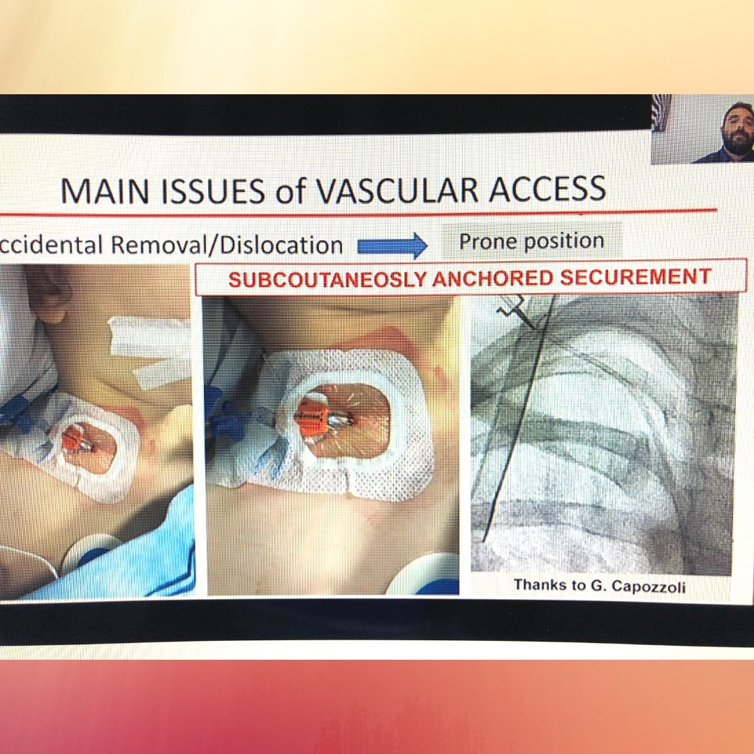 SecurAcath's tweet photo. SecurAcath is the ONLY subcutaneous catheter securement device! 
#wocovalive #wocova #securacath #lifeoftheline https://t.co/zEOQBwZSgj