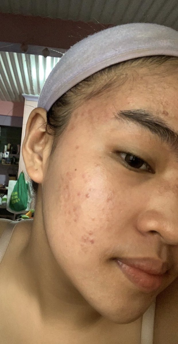 roldanhannah's tweet photo. my skin journey— a thread on how i overcame my biggest insecurity :) https://t.co/IOgdMTBm8x