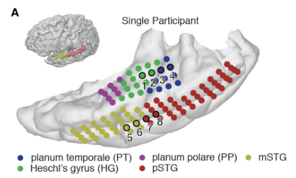 Here, we were able to record from 9 participants with simultaneous coverage of the temporal plane and lateral STG, allowing us to sample from a broad region encompassing primary auditory and parabelt regions. An example is shown below of coverage for one participant.