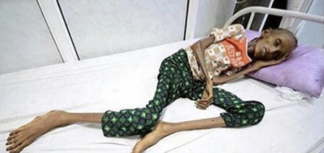 Every 10 minutes in Yemen a child dies