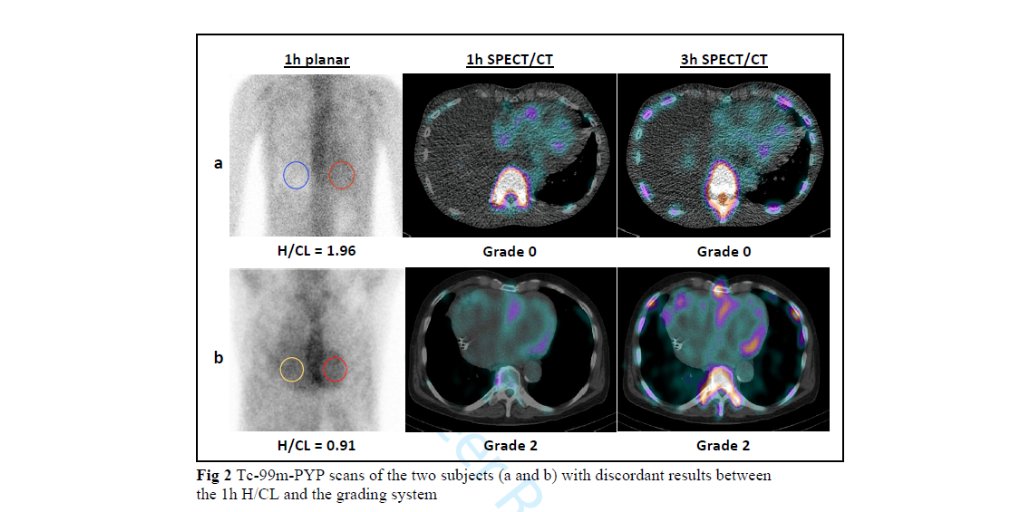 #JournalNC: Comparison of qualitative and Quantitative #PYP #CVNuc approaches for diagnosing #Amyloidosis. bit.ly/3e7ibyM @masriAhmadMD <a href="/RBP0612/">Renée Bullock-Palmer MD FACC FAHA FASNC FASE FSCCT</a> @myASNC <a href="/AIskandrian/">Ami Iskandrian</a> <a href="/DorbalaSharmila/">Sharmila Dorbala</a> pic.x.com/ze34Cm3djo