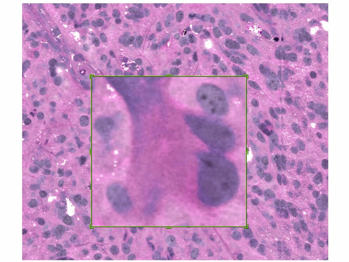 Invenio Imaging (@invenioimaging) on Twitter photo Thank you to all the speakers and attendees who participated in last week's 1st Stimulated Raman Histology #Neuropathology User Meeting. <a href="/CameloPiragua/">Sandra Camelo-Piragua</a> MD, Matija Snuderl MD, John Cupp MD and Melike Pekmezci MD. Great to kick off collaboration and future projects! #BrainTumor Thank you to all the speakers and attendees who participated in last week's 1st Stimulated Raman Histology #Neuropathology User Meeting. <a href="/CameloPiragua/">Sandra Camelo-Piragua</a> MD, Matija Snuderl MD, John Cupp MD and Melike Pekmezci MD. Great to kick off collaboration and future projects! #BrainTumor