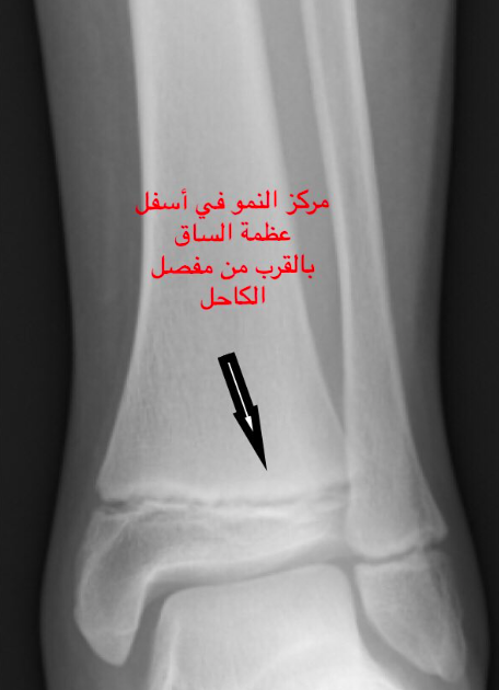 مراكز النمو الموجودة في عظم الطفل تقع عند نهايات العظم بالقرب من المفاصل كما هو موضح في الصور . تظهر في الأشعة كخط أسود منتظم في أطراف العظام الطويلة .. 