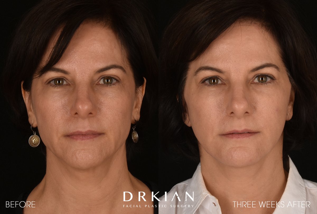 ⭐️ Micro Neck Lift with Fat Transfer to Chin & Cheeks #BeforeAndAfter Three Weeks
For appointments:
☎️ 424-644-2400
📧 info@RejuvaMedical.org
https://t.co/zhuyd0ls56 https://t.co/3upuXbI7jN