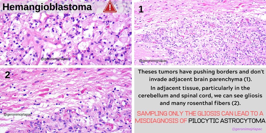 #neuropath
#pathology