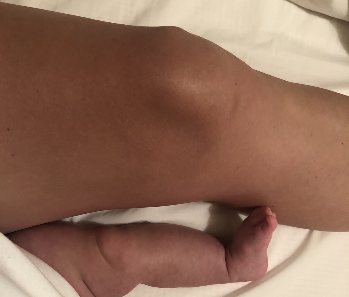 DrAmyGarner's tweet photo. Unexpected benefits of lockdown... being able to “attend” the #BASKAC with a noisy 10 week old baby..... great first @baskonline webinar.. “partial knee Arthroplasty the new gold standard for patients of all ages” #PatientSafety #CostEffective #ShortHospitalStays #BabySurgeon https://t.co/HrCNC4bC8O