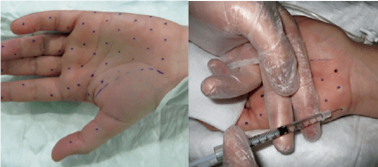 ✏️"Hiperhidrosis palmoplantar, ¿es tratable?", un artículo de la Dra. Alba Català (<a href="/albacatala_bcn/">Alba Català</a>), especialista en Dermatología general y Venereología (@hospitalplato, <a href="/Clinica_Teknon/">Centro Médico Teknon</a>) para el nº31 de la revista #EME. ➡️ bit.ly/37GwRCu 
#dermatologia #dermatology