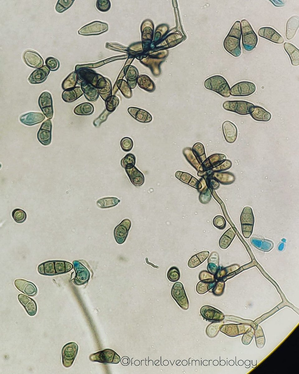 Curvularia spp on lactophenol blue prep

Etiologic agents of opportunistic infections, most commonly causing keratitis and allergic/chronic sinusitis. Also causes onychomycosis, mycetoma and phaeohyphomycosis at various sites, including subcutaneous tissue and deep tissues.