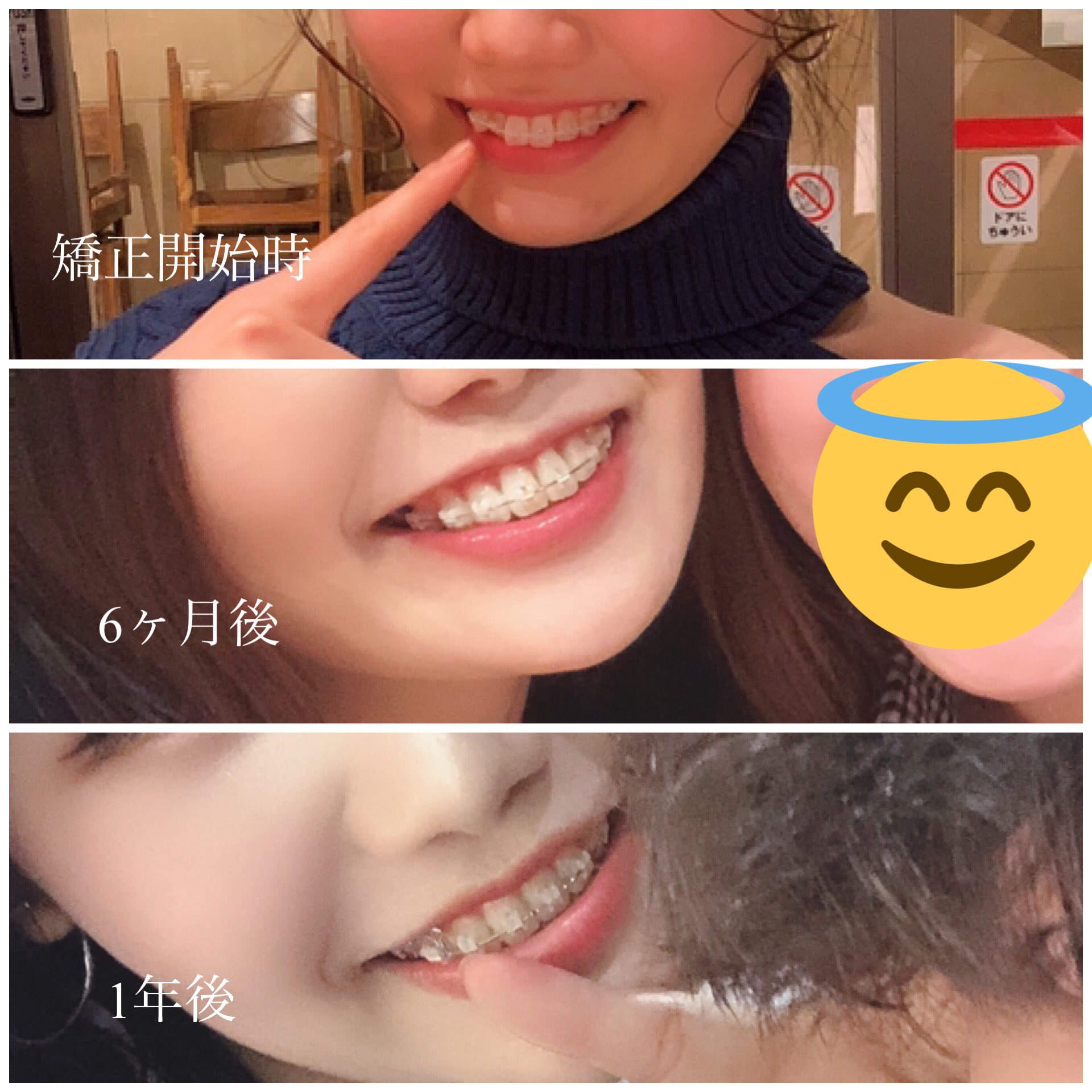 かなちゃん 矯正始めてから半年後と1年後の比較 半年くらいでだいたい並んでるけど出っ歯感まだまだあるね 笑 歯並び も変わったけど顔が全体的に変わった 口元が引っ込むからか鼻がスッキリして高くなったように見えるし顔の筋肉のつき方も変わるし輪郭