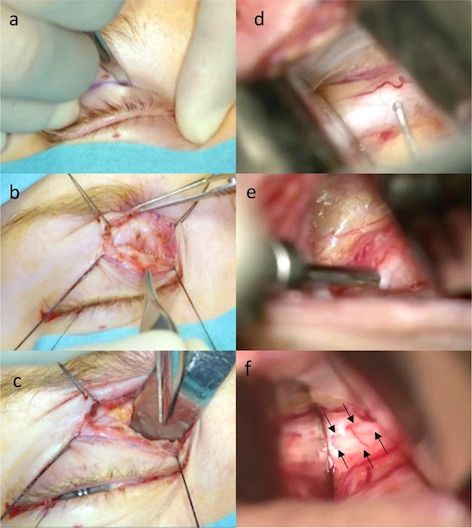 Eye_Journal's tweet photo. Now Online: Optic nerve sheath fenestration via a supero-medial eyelid skin crease approach for the treatment of idiopathic intracranial hypertension in a UK population
@DrJefferis; @drsachinsalvi
#Ophthalmology https://t.co/DQ9BPzKPQL https://t.co/ou9467L029
