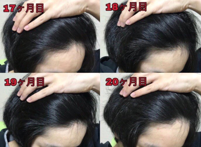 Agaアニキ Sur Twitter 右の生え際 22ヶ月分 Aga ハゲ 若ハゲ Aga治療 薄毛 薄毛対策 薄毛改善 Agaアニキ Sur Twitter 右の生え際 22ヶ月分 Aga ハゲ 若ハゲ Aga治療 薄毛 薄毛対策 薄毛改善