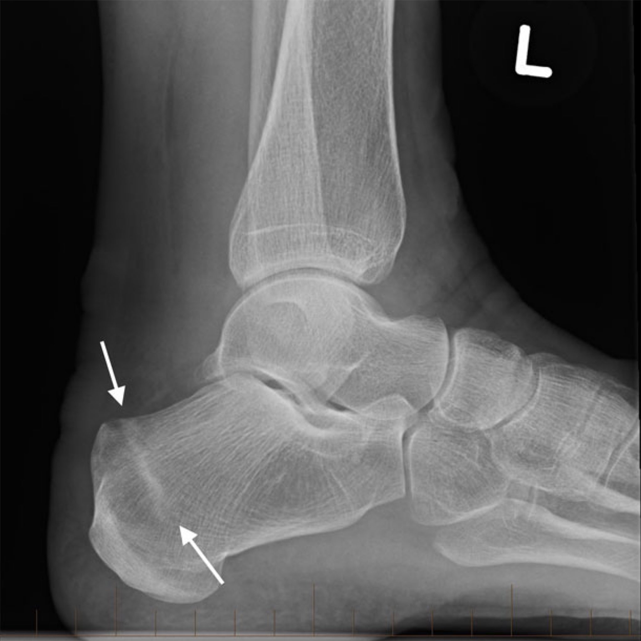 Heel bone shop stress fracture