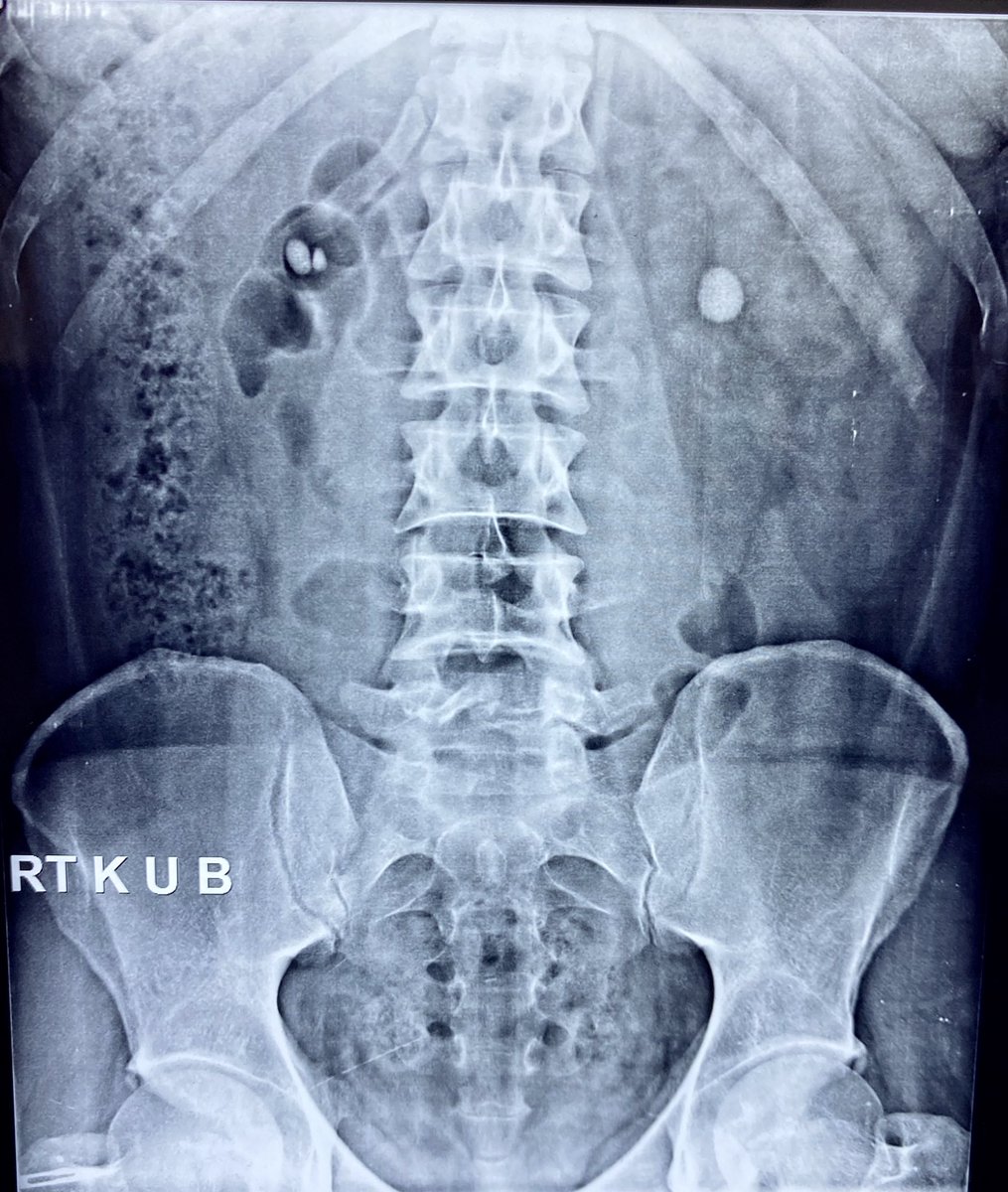 SudheerDevana's tweet photo. Posterior #calyces are sometimes oriented 70 degrees posterior to frontal plane of #kidney. Hence they are seen medially on #IVU (white arrow: Mid posterior calyx; black arrow: mid anterior calyx) #PCNL #pcnl #urolithiasis #renalstone https://t.co/77nyoRofa8