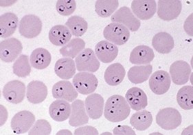 Interesting blood film from the tropics.
<a href="/underthe_scope/">margot.</a> What do you see?