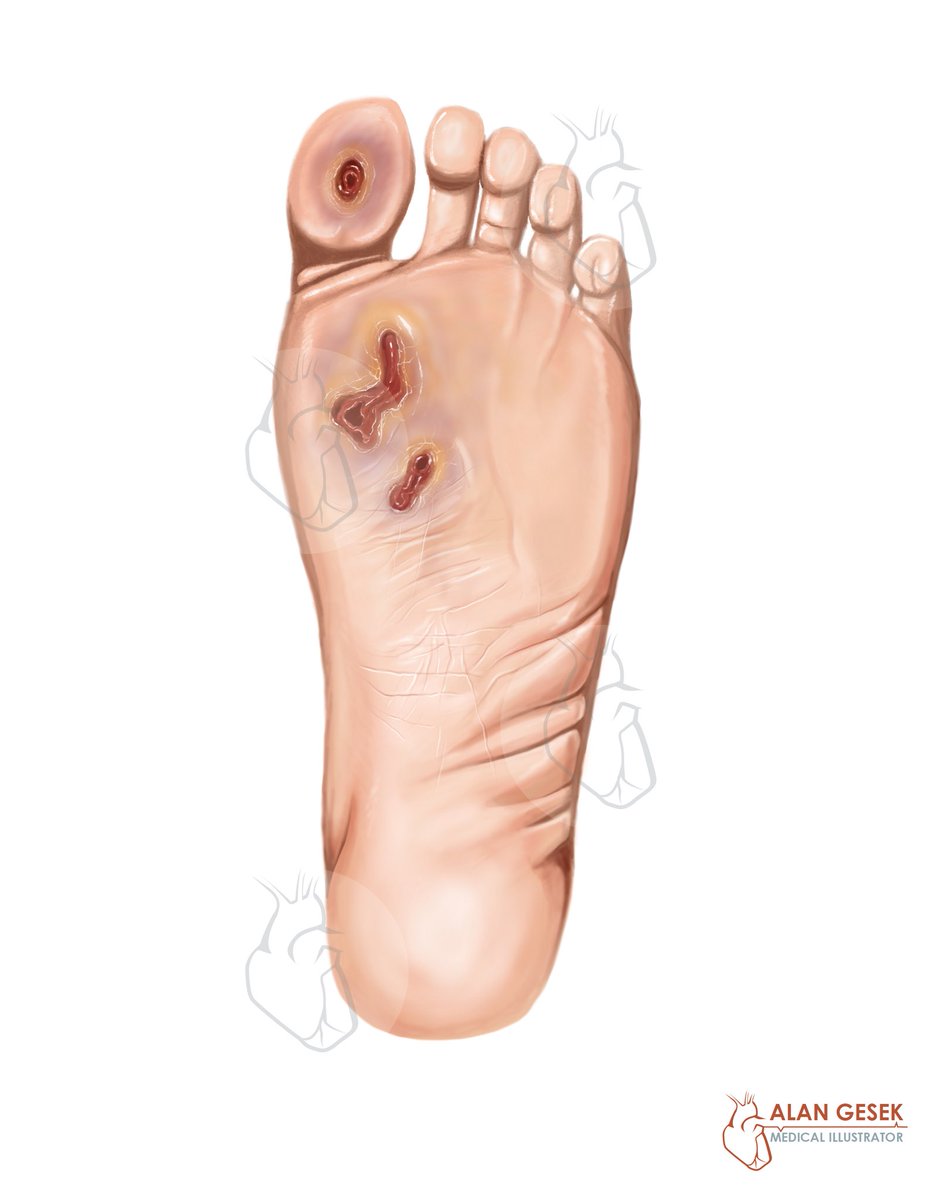 alangesek007's tweet photo. Here’s some brand new freelance #medicalillustration for a recent client focusing on #uclers or #diabeticwounds on the #foot 🦶 and #lowerleg . Painted on the #ipadpro  in @Procreate Looking forward to sharing more awesome pieces 🎨 soon! #digitalart #anatomy #art #illustration https://t.co/fV0Vxhok1s