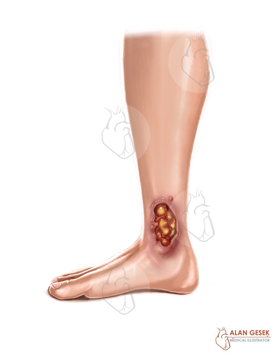 alangesek007's tweet photo. Here’s some brand new freelance #medicalillustration for a recent client focusing on #uclers or #diabeticwounds on the #foot 🦶 and #lowerleg . Painted on the #ipadpro  in @Procreate Looking forward to sharing more awesome pieces 🎨 soon! #digitalart #anatomy #art #illustration https://t.co/fV0Vxhok1s