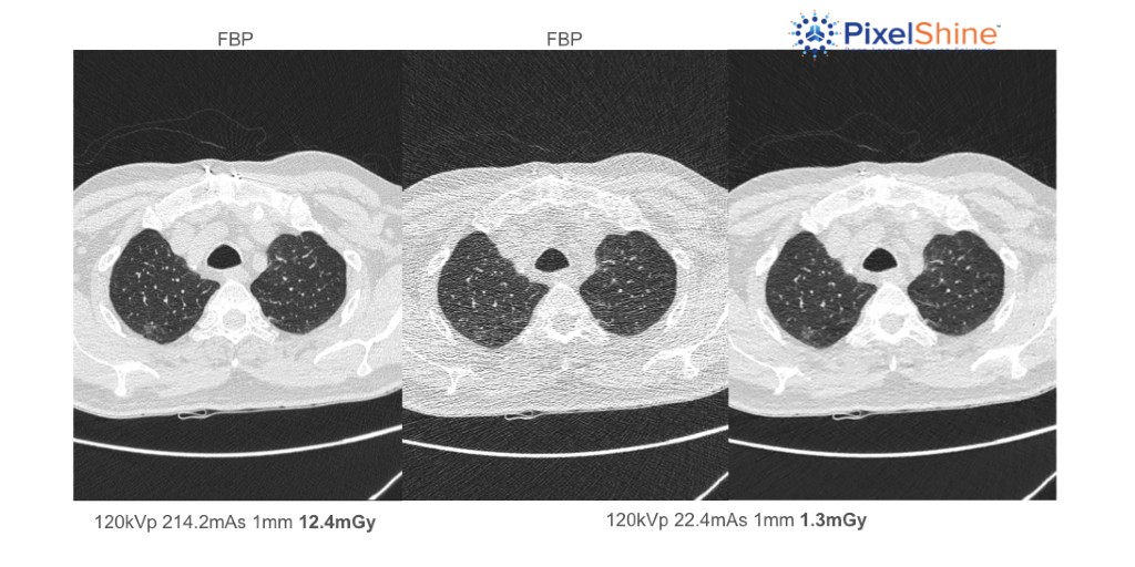algomedica's tweet photo. PixelShine overcomes the limitations of standard CT image reconstruction techniques. It improves the quality of any CT exam and it is vendor agnostic and works with any CT scanner.
Learn more: https://t.co/ZhMpwpkp4H
#AI #radiology #lungs #ctscan #Healthcare #lowdoseCT https://t.co/kjjdOOtQH4