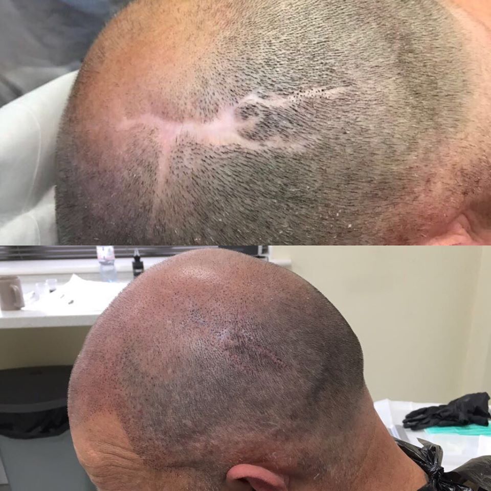 The non-invasive scalp micropigmentation treatment gives the illusion of a fuller head of hair by placing tiny pigments of ink that resemble shaved hair follicles on the scalp. It offers an effective solution for hair loss, and camouflaging scars and burns!