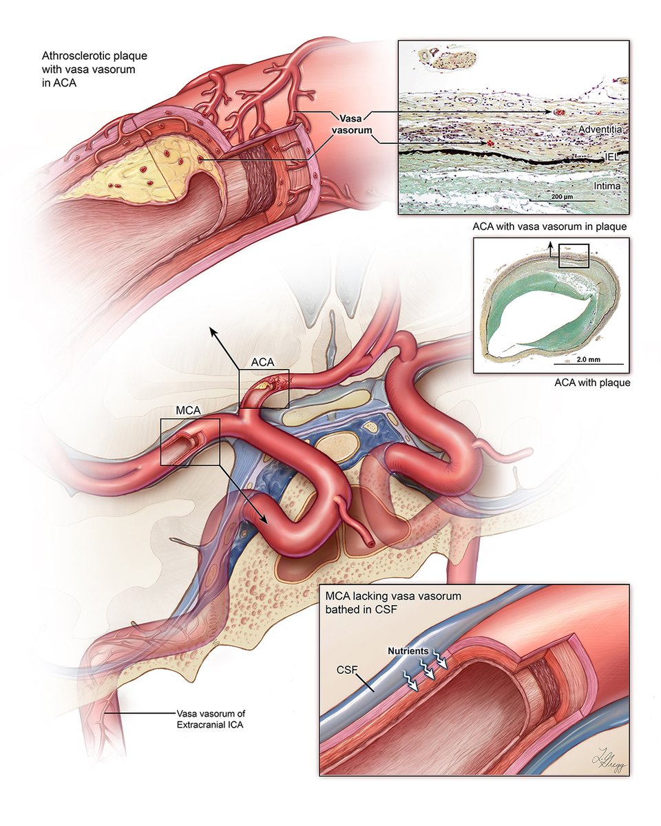 Illustration of the formation of intracranial vasa vasorum with atherosclerotic plaque for Dr. Bruce Wasserman.  #sciart #medicalillustration pubs.rsna.org/doi/10.1148/ra…