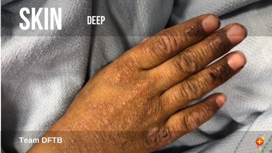 TessaRDavis's tweet photo. The @DFTBubbles team have joined together with @RLHPED to launch our project Skin Deep. Our aim is to improve the diversity in paediatric skin images online. 

Join us, collaborate, get involved. Let's make this a great project.

https://t.co/rGL0KECeFx https://t.co/pJou4WzkEQ