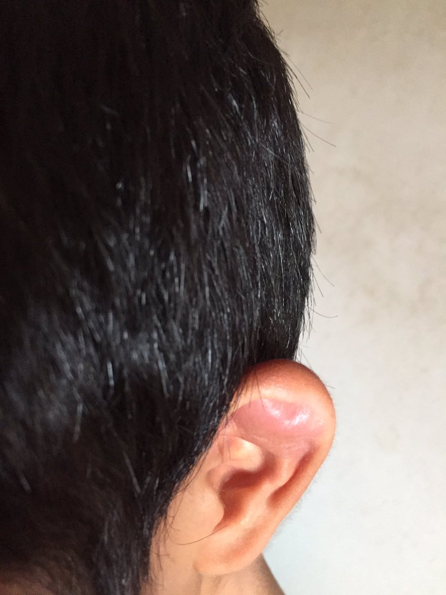 翔音 On Twitter 息子の耳にビックリ ºdº エエ いつから格闘家になった って ふざけてる場合ではないな 皮膚科は 15 00で終わり 耳鼻科は 午後から休診 タイミング悪すぎた 針でも焼くか