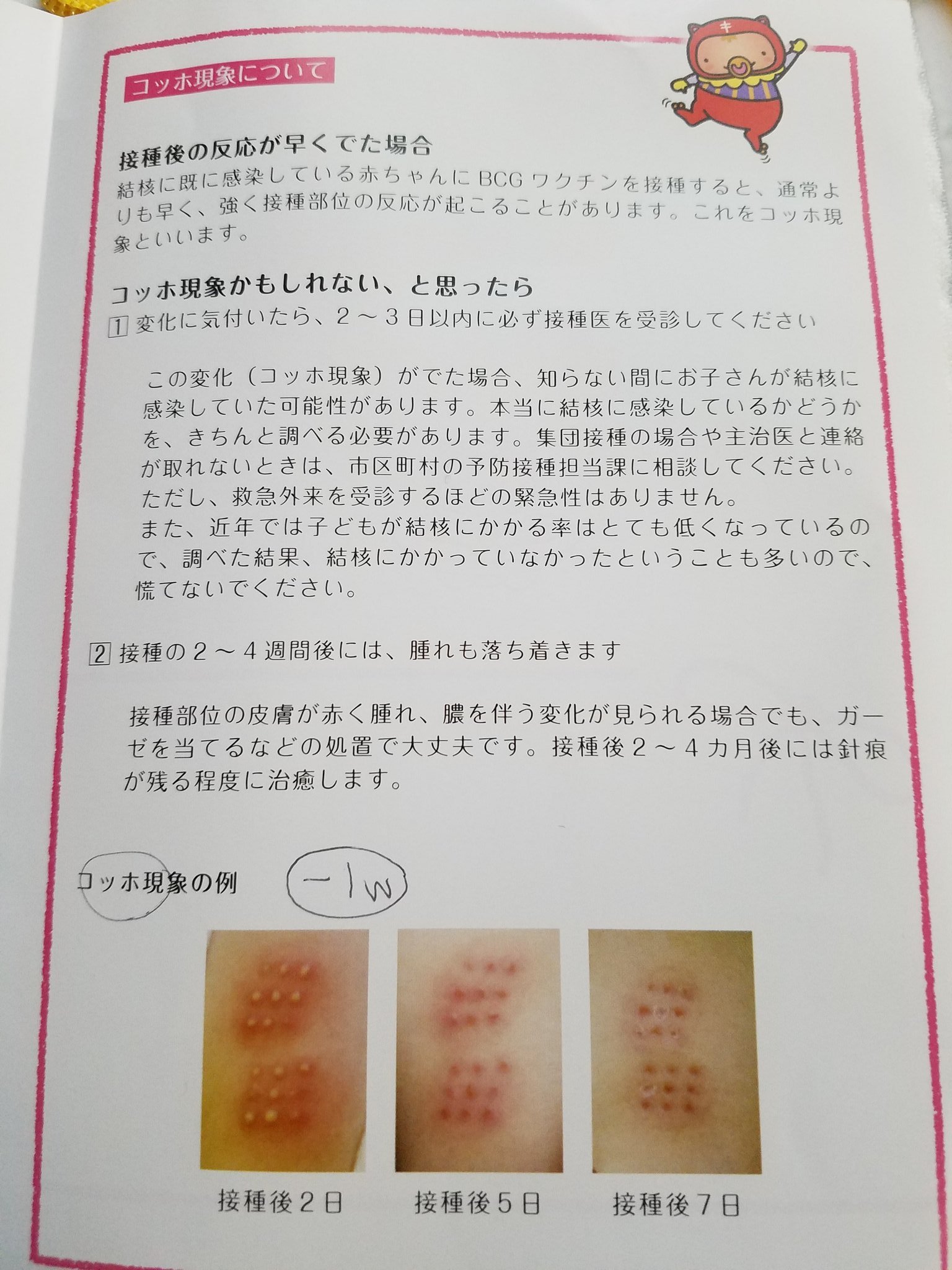 うずら 1y5m 左当日 右今日 なんだか赤くなってきた 先生は赤くなっても白く膿んだりしてこなかったら大丈夫って言ってた うずらbcg経過観察