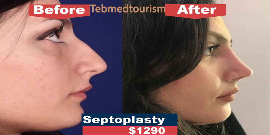 TebMedTourism's tweet photo. Septoplasty and Rhinoplasty in Iran
You can save up to 80% by having your #nose_job in Iran.
https://t.co/K3GF4YGsfc
Let's chat on whatsapp: 00989120985010
#rhinoplasty #septoplasty #cosmetic_surgery #cosmetic #health_tourism #medical_travel #treatment_in_iran #travel_iran https://t.co/Bx6edGh6TN