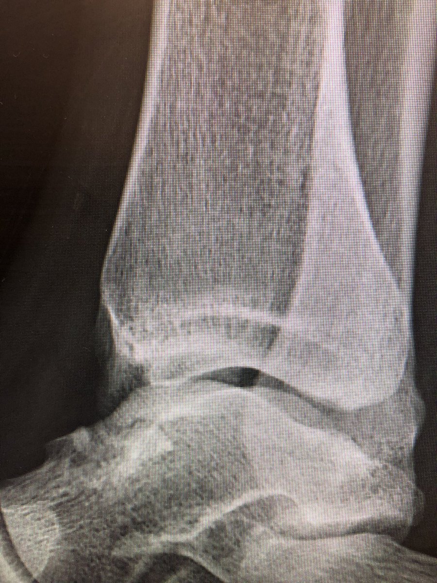 [1/14] Xrays (like hips) don’t lie: a thread. Look at these X-rays before going onto the polls in the next tweets and decide how you’d treat. This medial mal is isolated (nothing higher up, no fibula fracture) in a middle aged patient.
