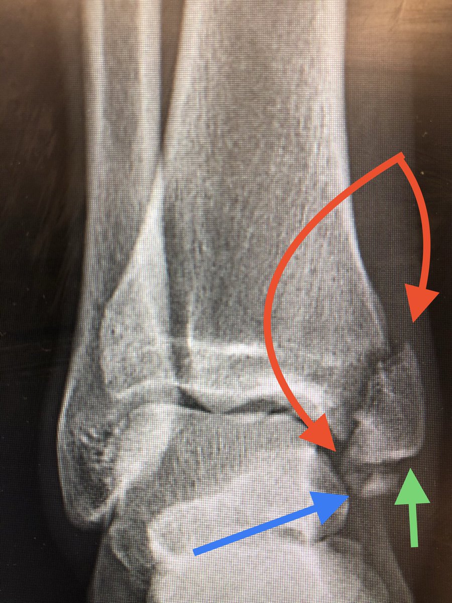 [8/14] In fact even without CT, careful assessment of X-rays tells you something is odd. The shape of this is weird, curve is wrong. It looks flat (green). Fracture looks wider than its bed (red). And also, additional piece (blue) that makes me wonder about PT tendon sheath.