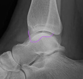 [9/14] Now to lateral. The normal shape of medial mal has curved colliculi (purple) reaching back to overlap fibula. Here, even though not perfect lateral (talar domes, red), the shape looks flat and never reaches fibula. Even if you “build back” small fragment, still not right.