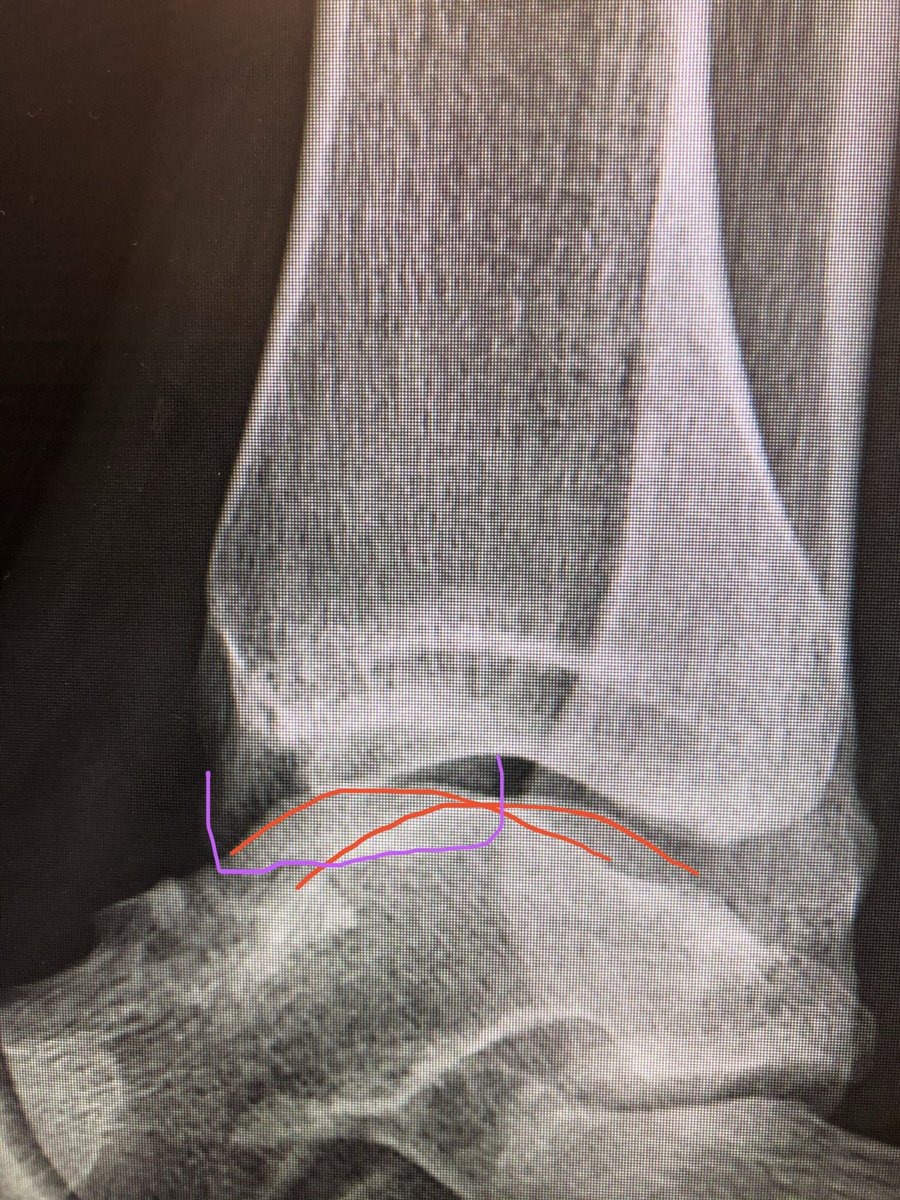 [9/14] Now to lateral. The normal shape of medial mal has curved colliculi (purple) reaching back to overlap fibula. Here, even though not perfect lateral (talar domes, red), the shape looks flat and never reaches fibula. Even if you “build back” small fragment, still not right.