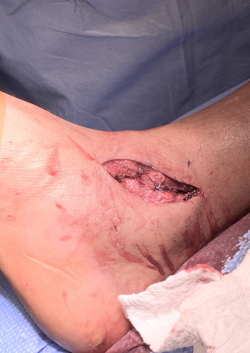 [13/14] Final images, and clinical image after sutures from anchor oversewing the busted soft tissues. Tendon didn’t subluxate on testing. Closed and nwb x 6 weeks.