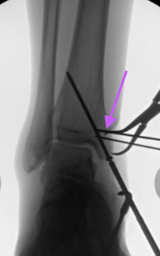 [11/14] I shoved piece back behind tendon so it lay in its bony bed, being careful not to nab anything else (bundle). Held with K-wires & separate visualization wire (purple) like you’d do in acetabulum so could see reduction. To keep drill from slipping, used drill guide on tip.