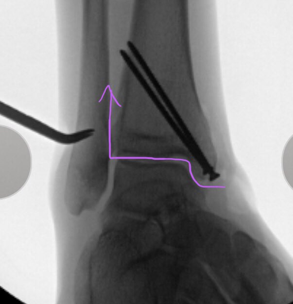 [12/14] Added second bicortical screw posteriorly for compression (countersunk, otherwise was rubbing tendon), then fixed sheath and separate deltoid avulsion with suture anchor. Then did a perc cotton stress to make sure force didn’t propagate beyond medial mal (it didn’t).