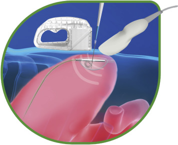 JVIRmedia's tweet photo. Percutaneous Ultrasound Gastrostomy: First-in-Human Experience with the PUMA-G System | https://t.co/SDNUYsK7Is #irad @DerekWCool https://t.co/aOsQMyrlGR