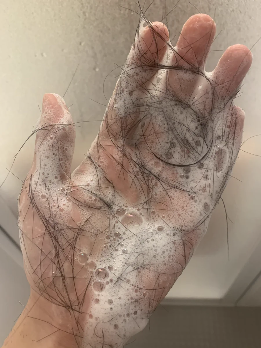 抗がん剤の副作用の脱毛を知らない人へ！10秒くらい頭洗うとこうなるらしい‼