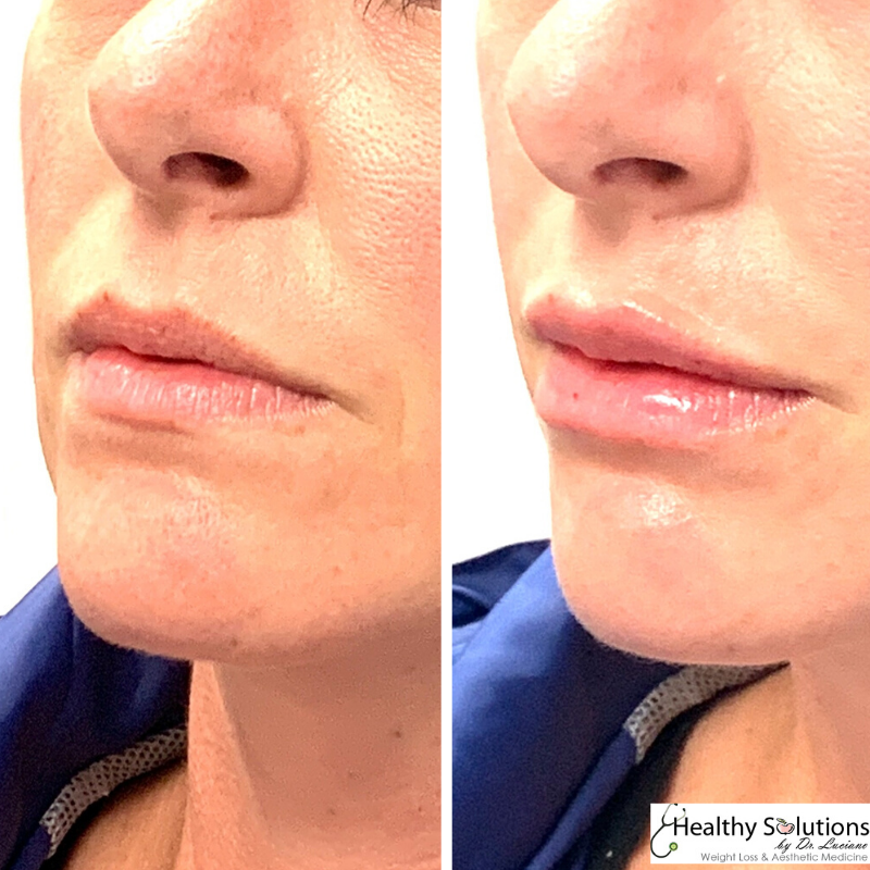 HlthySolMedSpa's tweet image. Love your lips at our #medspa
#buckscounty #buckscountypa #medicalspa 
#lips #lipinjections #lipfillers

Visit our website here:
healthysolutionsdr.com