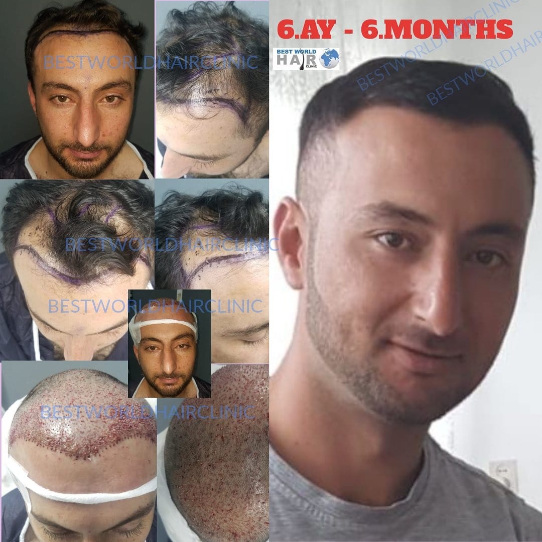 Best World Hair Clinic on Twitter: Best World Hair Clinic on Twitter: