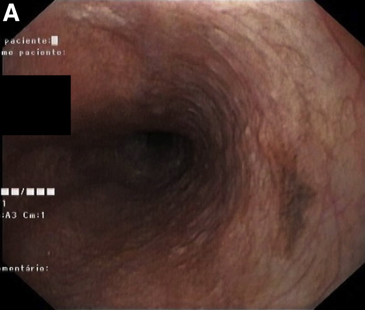 What's your diagnosis? Intermittent dysphagia for solids over 2 months bit.ly/38fMh0T